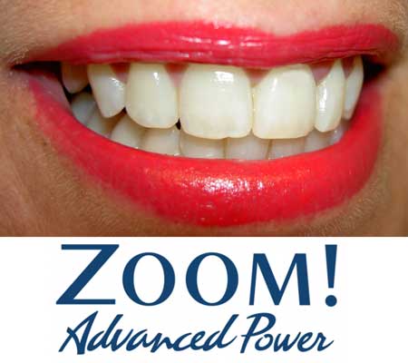 Zoom! Advanced Power Teeth Whitening